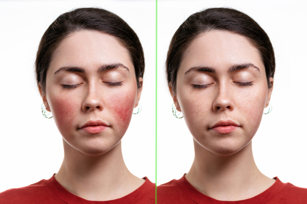 Rosacea Nutritionist and Dietitian JM Nutrition